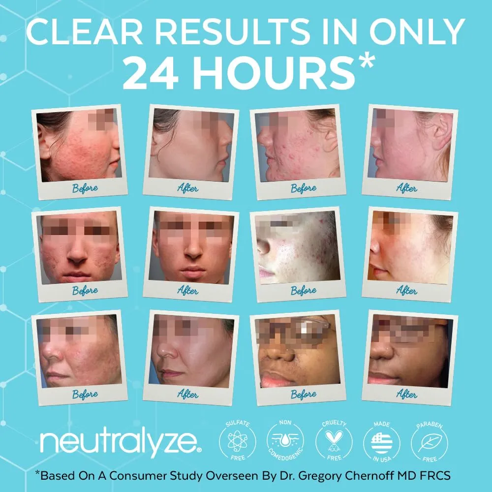 Acne Treatment Gel with 2% Mandelic Acid & 2% Salicylic Acid - Severe Acne Serum, Scar & Spot Treatment for Face (90 Day)