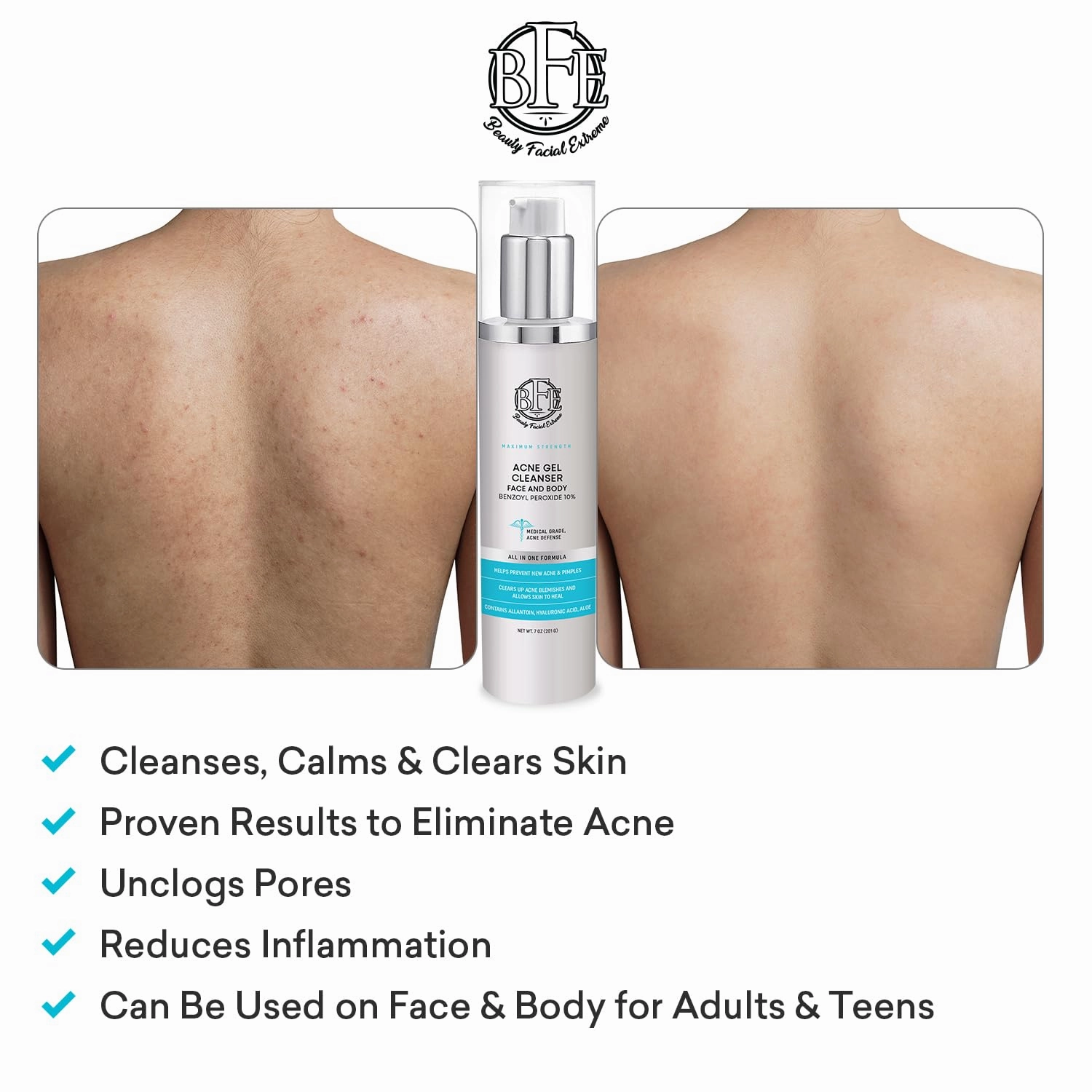 Acne Face wash Treatment with Benzoyl Peroxide 10% - Fight Acne Blemishes on Contact for Cystic Breakouts, Oily Skin, Clogged Pores, Blackhead, Whitehead & Pimples. Achieve Clear Skin.