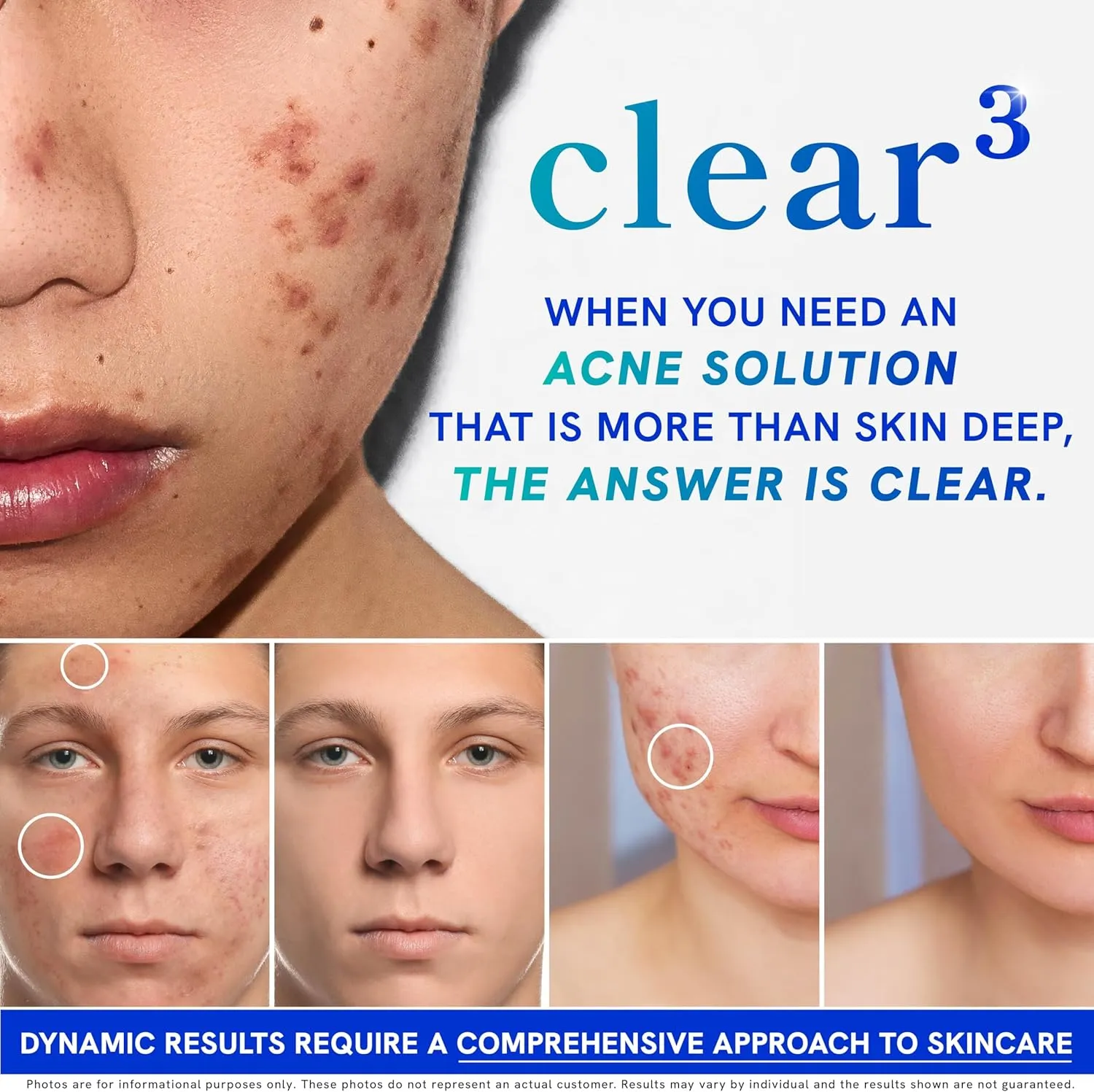Clear Skin Acne Supplement with Zinc, DIM & Probiotics | 3-in-1 Balance, Clarify, Restore Support with Hyaluronic Acid & Skin Support Vitamins | for Women & Men | Oral Hormonal Acne Pills | 60 Ct
