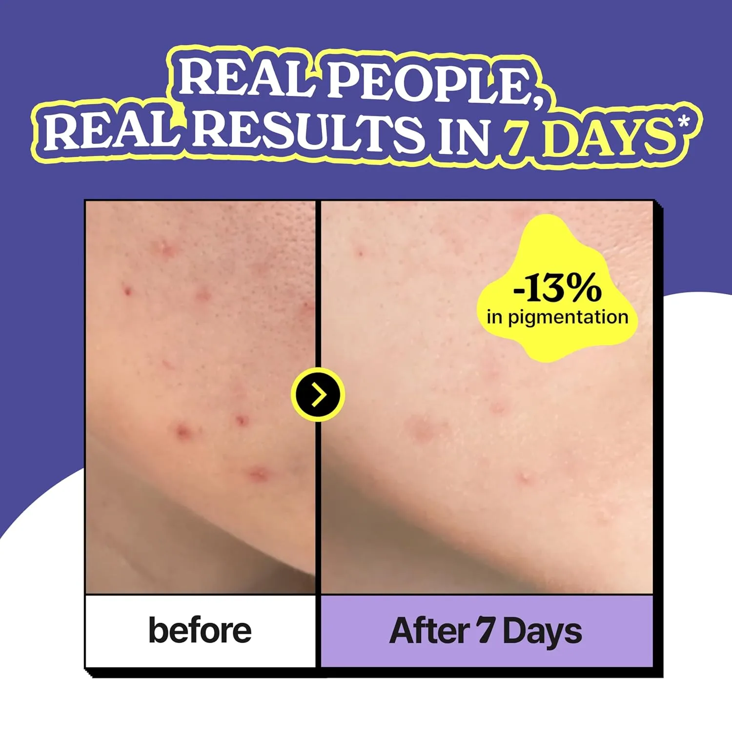 Niacin Onion All Clear Ampoule | Acne Dark Spot Serum for Face | Red Onion, 5% Niacinamide, and Vitamin C | Glass Skin, Evens Tone | Korean Skincare | Cruelty-Free (40ml, 1.35 fl. oz.)